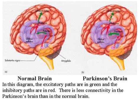 parkinson's disease brain vs normal brain